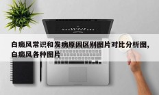 白癜风常识和发病原因区别图片对比分析图,白癜风各种图片