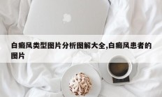 白癜风类型图片分析图解大全,白癜风患者的图片