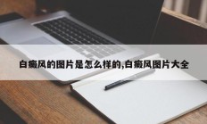 白癜风的图片是怎么样的,白癜风图片大全
