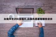 白癜风常识科普图片,白癜风患者有哪些症状