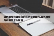 白色糠疹和白癜风的区别症状图片,白色糠疹与白癜风怎么区别