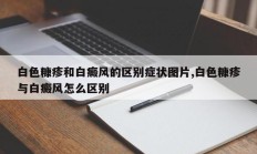 白色糠疹和白癜风的区别症状图片,白色糠疹与白癜风怎么区别