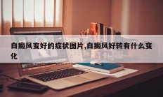 白癜风变好的症状图片,白癜风好转有什么变化