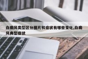 白癜风类型区分图片和症状有哪些变化,白癜风典型症状