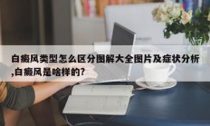 白癜风类型怎么区分图解大全图片及症状分析,白癜风是啥样的?