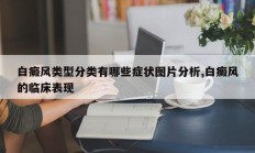 白癜风类型分类有哪些症状图片分析,白癜风的临床表现