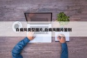 白癜风类型图片,白癜风图片鉴别