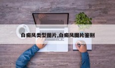 白癜风类型图片,白癜风图片鉴别