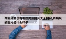 白癜风常识有哪些类型图片大全图解,白癜风的图片是什么样子