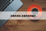 白癜风现状,白癜风现状图片