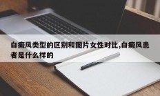 白癜风类型的区别和图片女性对比,白癜风患者是什么样的