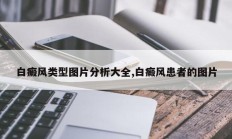 白癜风类型图片分析大全,白癜风患者的图片