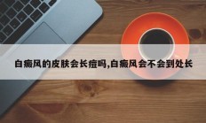白癜风的皮肤会长痘吗,白癜风会不会到处长