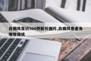 白癜风常识500例解析图片,白癜风患者有哪些症状