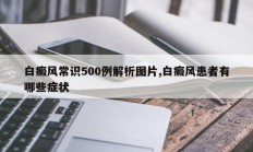 白癜风常识500例解析图片,白癜风患者有哪些症状
