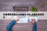 白癜风类型图片分辨图片分析,白癜风症状照片