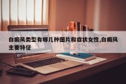 白癜风类型有哪几种图片和症状女性,白癜风主要特征