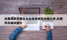 白癜风类型图片大全简单概括为哪几种,白癜风白癜风图片