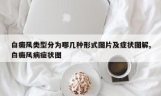 白癜风类型分为哪几种形式图片及症状图解,白癜风病症状图