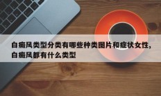白癜风类型分类有哪些种类图片和症状女性,白癜风都有什么类型
